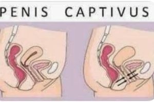 SANTÉ/PENIS CAPTIVUS CHEZ LES HOMMES : Ce qu&rsquo;il faut savoir de cet accident
