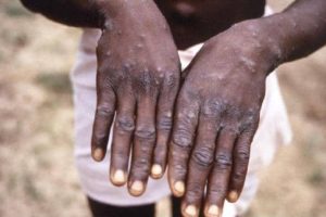 ÉPIDÉMIE DE MONKEY POX EN AFRIQUE : Le Maroc enregistre son premier cas